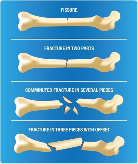 Traduction bombe Faire un effort commutative fracture Médecine légale distance Affiner