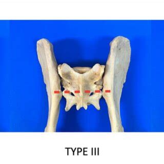 FIGURE E Drawings showing the sacral fractures following the... | Download Scientific Diagram