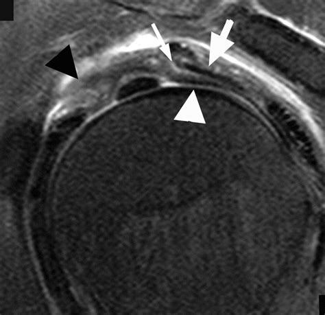 MRI of the Rotator Interval Capsule | AJR