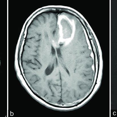 CT showed high-density lesion in the left frontal lobe (a). MRI images ...