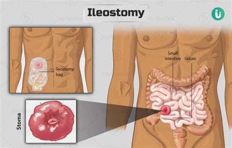 Ileostomy: Procedure, Purpose, Results, Cost, Price