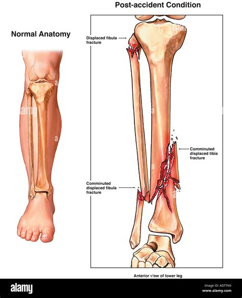 Compound Fracture Diagram