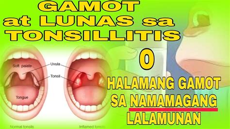 Halamang Gamot sa namamagang Lalamunan | Tonsillitis | - YouTube