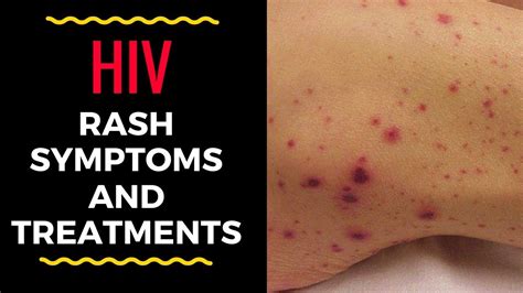 Hiv Symptoms Rash - Infoupdate.org