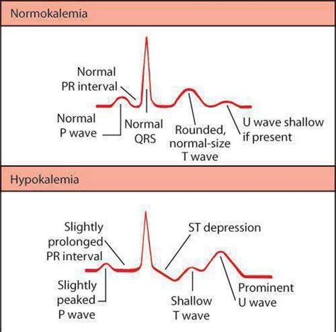 Normal vs. Abnormal Sinus Rhythm | Ekg interpretation, Nursing mnemonics, Nursing notes