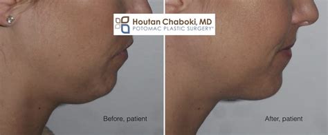 Chin Liposuction to improve a Double Chin