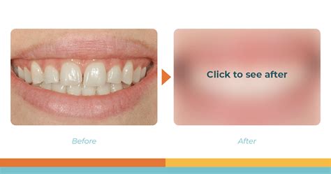 Dental Bonding Before and After Photos | Smile Makeover | Arch Dental