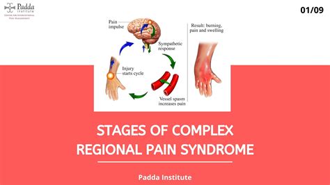 Stages Of Complex Regional Pain Syndrome by Padda Institute – Center ...