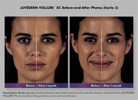 Juvederm Vollure XC | Deerfield Dermatology