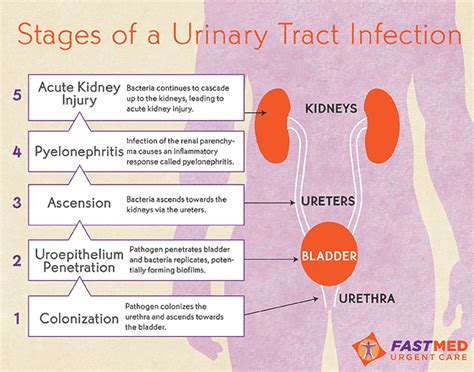 stages of UTI | Anatomy Academy | Pinterest | Best Urinary tract ...