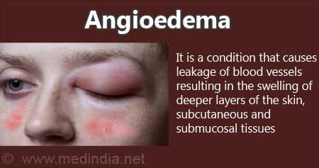 Urticaria And Angioedema | ubicaciondepersonas.cdmx.gob.mx