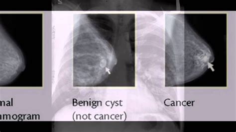 breast cancer x ray - YouTube