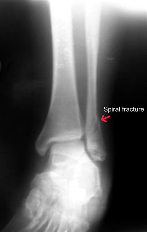 Spiral Fractures :: Bone Fracture & Repair