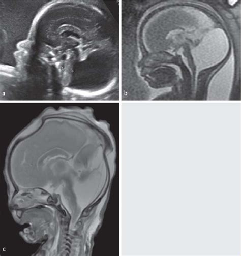 a Dandy-Walker malformation at 27 weeks of gestation. Mid-sagittal ...