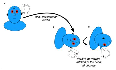 | Modified Semont maneuver for left apogeotropic LC-BPPV. Data modified ...