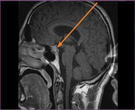 Pre-surgery, the first MRI, T1-weighted (sagittal) – the pituitary ...