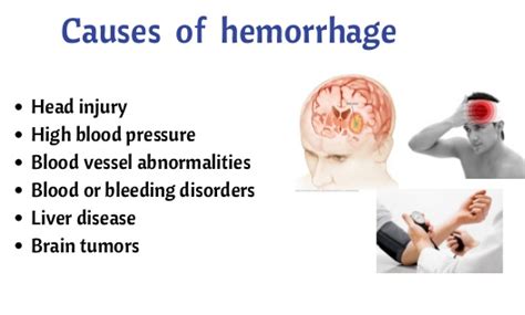 Brain hemorrhage symptoms and treatments - Life style and Fitness