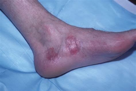 Prevalence of Psoriatic Arthritis Quantified in Patients With Psoriasis ...