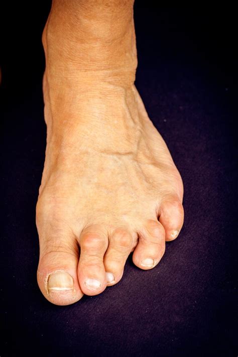 How To Treat Overlapping Toes | Dr. Lance Silverman