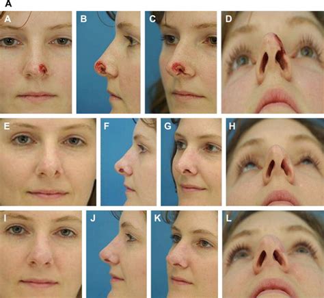 Cartilage Grafting in Nasal Reconstruction | Plastic Surgery Key