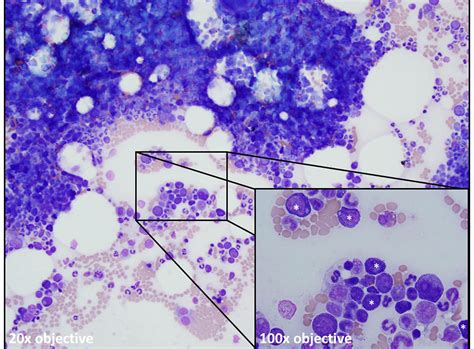 Demystifying Bone Marrow Evaluation