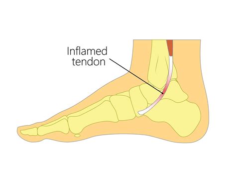 Posterior Tibial Tendonitis – Foot Scientific Store