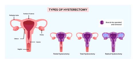 Hysterectomy for early cervical cancer treatment - Happiest Health