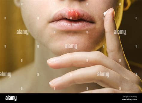 Herpes Zoster Face Stock Photos & Herpes Zoster Face Stock Images - Alamy