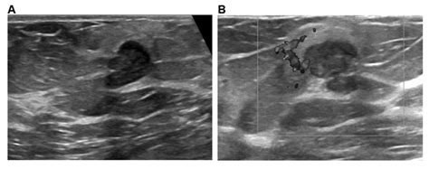 Diagnostic evaluations of ultrasound and magnetic resonance imaging in ...