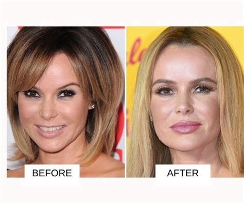 25 Most Popular Celebrities With Lip Fillers: Before And After With Images | Fabbon