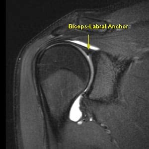 The Best Portland 3T MRI | Posterior Labrum Tear: 3T MRI Arthrogram Shoulder