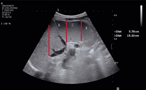 From spleen hilus to lower pole, the spleen was divided into 3 parts.... | Download Scientific ...