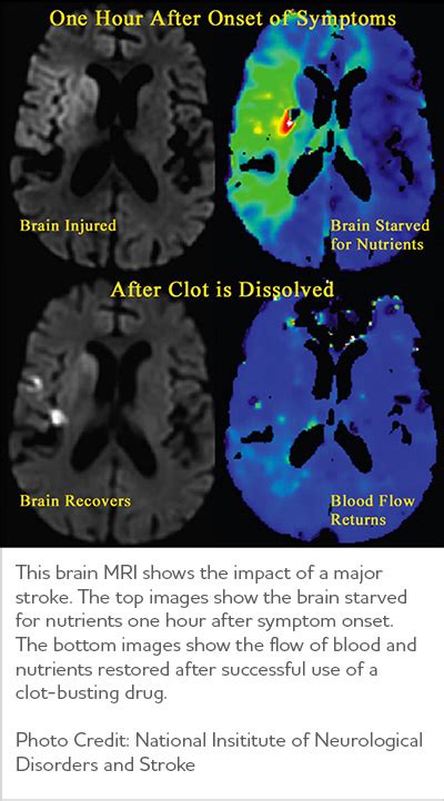 Vascular Dementia | Symptoms & Treatments | alz.org