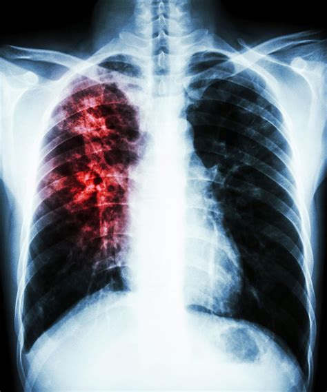 Tuberculosis case reported in Syracuse school district | State and Regional | auburnpub.com