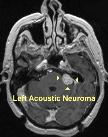 Acoustic Neuroma MRI Images