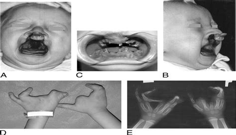 Ectrodactyly-Ectodermal Dysplasia-Clefting Syndrome-Plastic ...