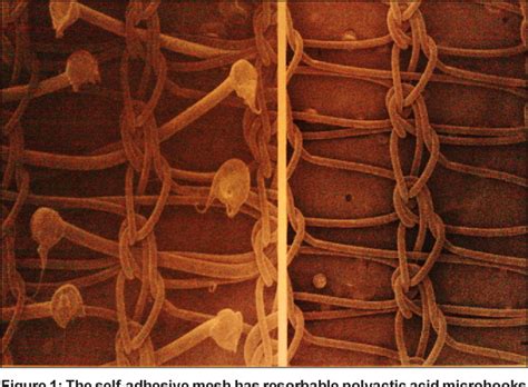 Figure 1 from Laparoscopic preperitoneal mesh repair using a novel self ...