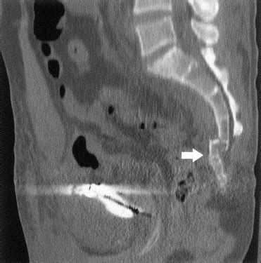 Imaging of Sacral Fractures - Clinical Radiology