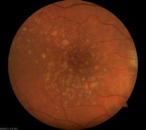 dry_amd – Central Texas Retina & Vitreous