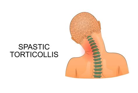 The Benefits of Physical Therapy for Torticollis in Children - Physical ...