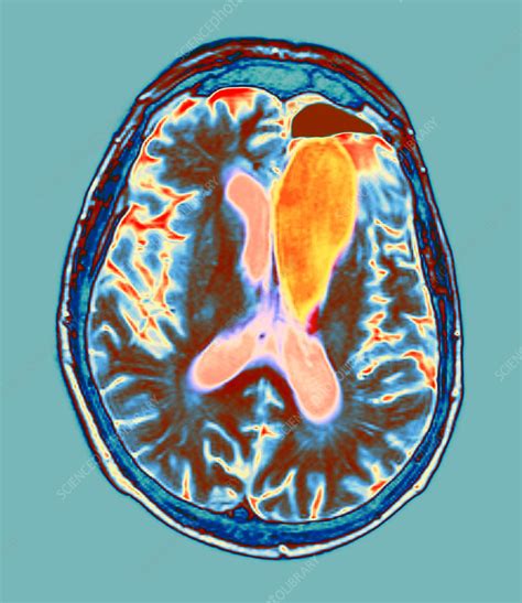 Brain cancer treatment, MRI scan - Stock Image - M134/0560 - Science Photo Library