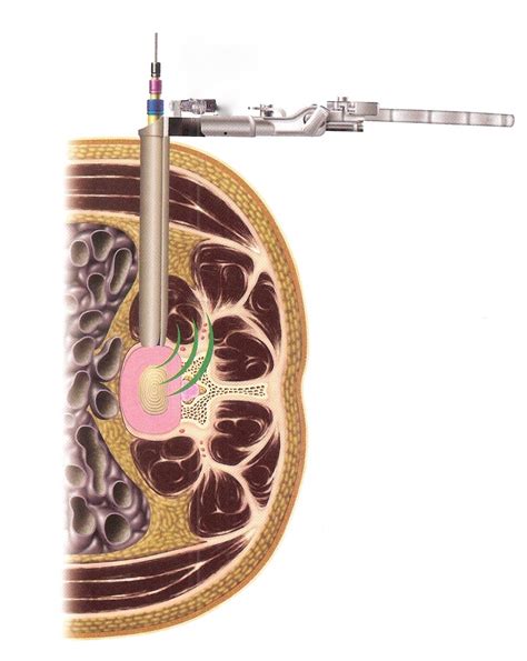 Extreme Lateral Minimally Invasive Fusion (XLif) - Spinecare Medical Group