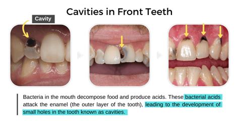 Cavities in Front Teeth: Causes & Treatment Options - Share Dental Care