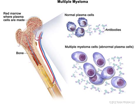 Plasma Cell Neoplasms (Including Multiple Myeloma)—Patient Version - NCI