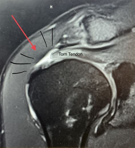 Why Did My Rotator Cuff Tear? - Johnny Nelson