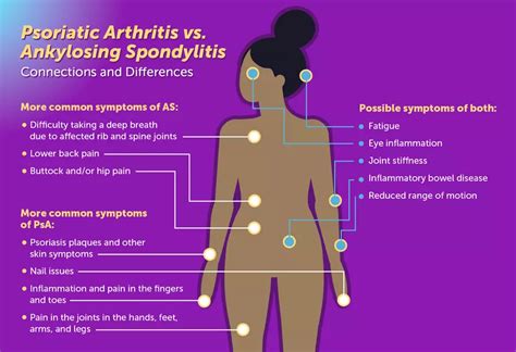 Psoriatic Arthritis vs. Ankylosing Spondylitis: Connections and Differences | MyPsoriasisTeam