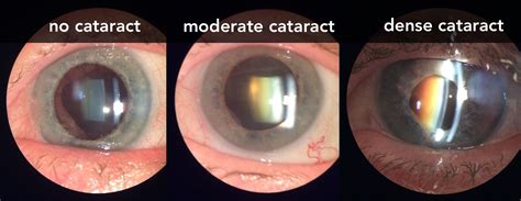 Cataract - Cataract surgery: Types, what to expect, and recovery ...