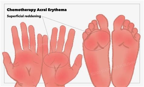 [Figure, Chemotherapy Acral Erythema, reddening, hands, feet StatPearls ...