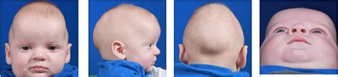 Craniosynostosis causes, symptoms, treatment & craniosynostosis surgery