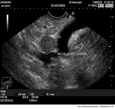 Detection of pancreatic neuroendocrine tumors: 23 years of experience | Revista de ...